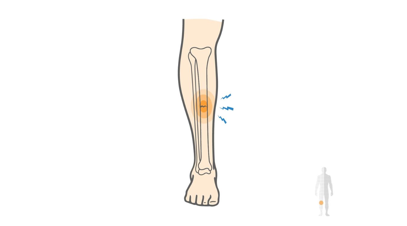 stress-fracture-quiz