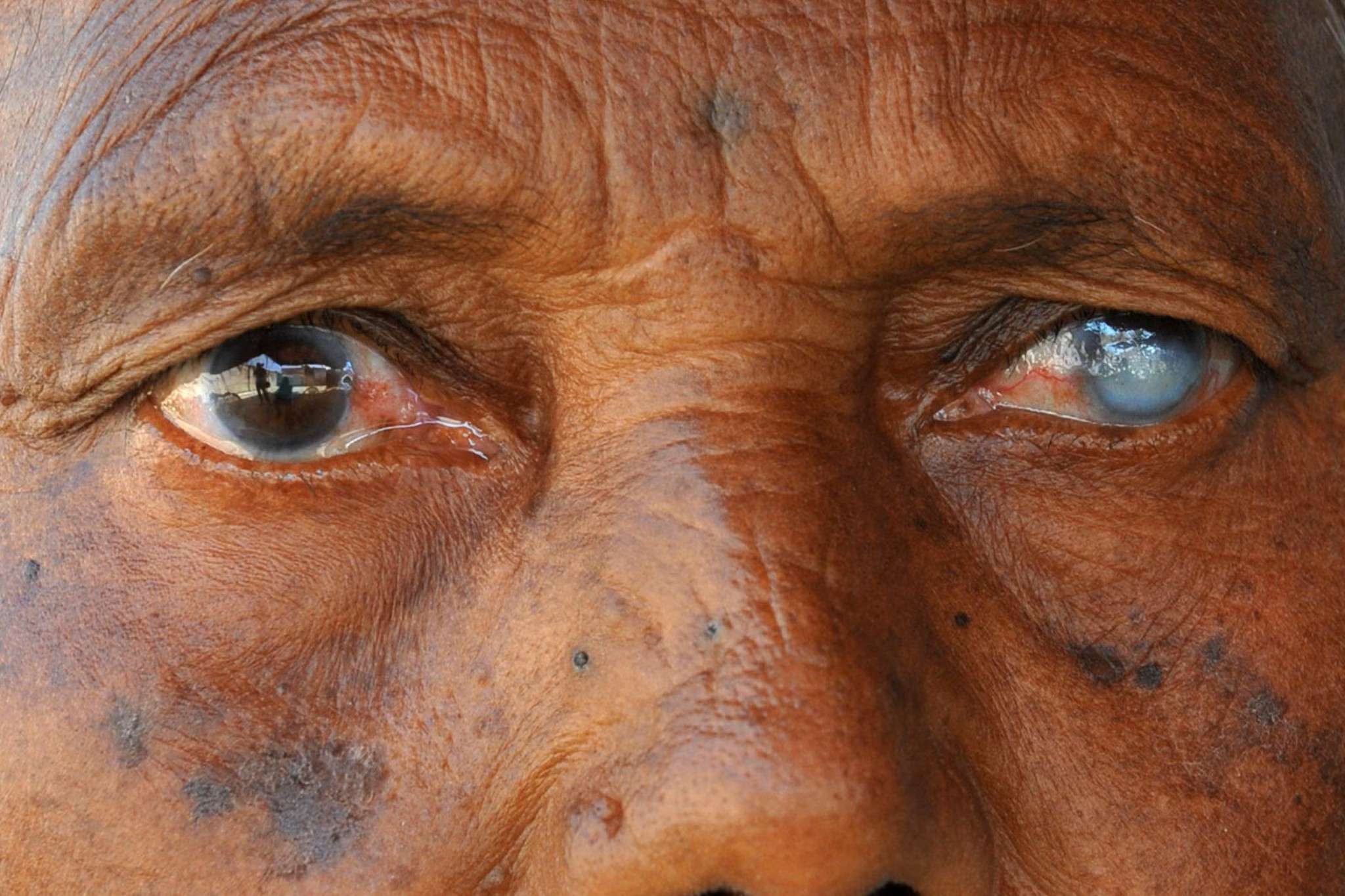 blindness-quiz