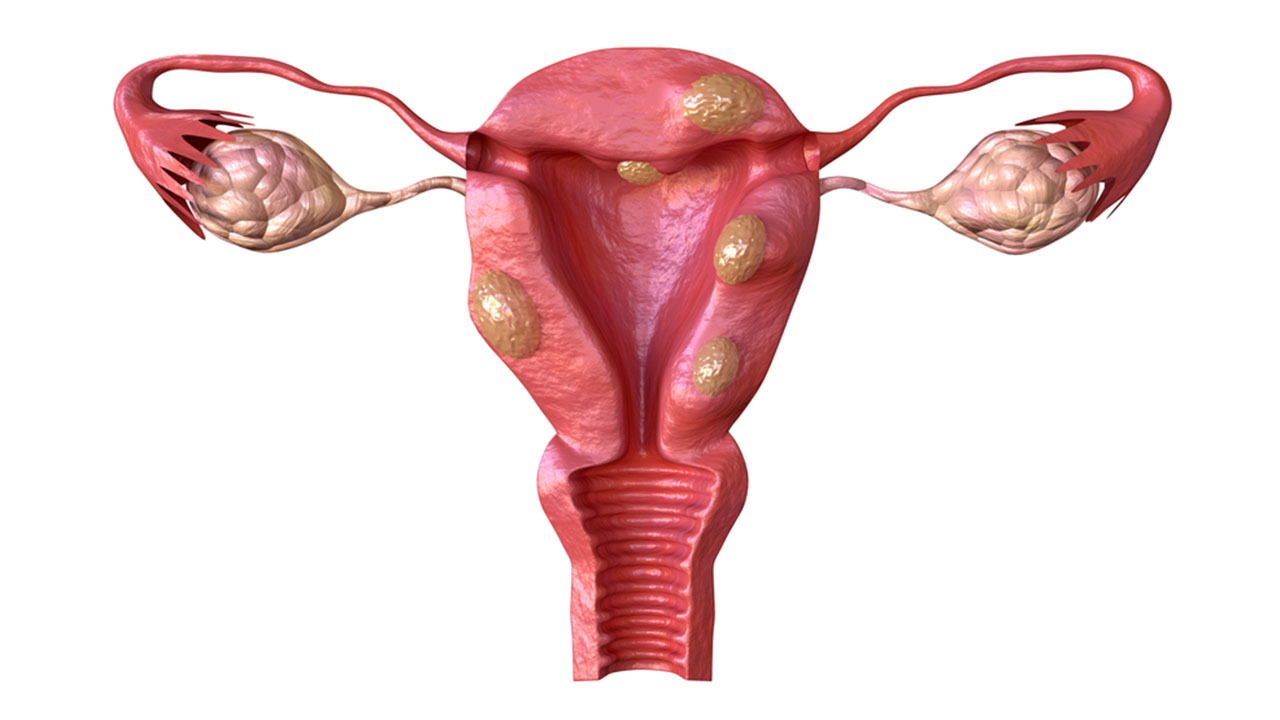 fibroid-quiz