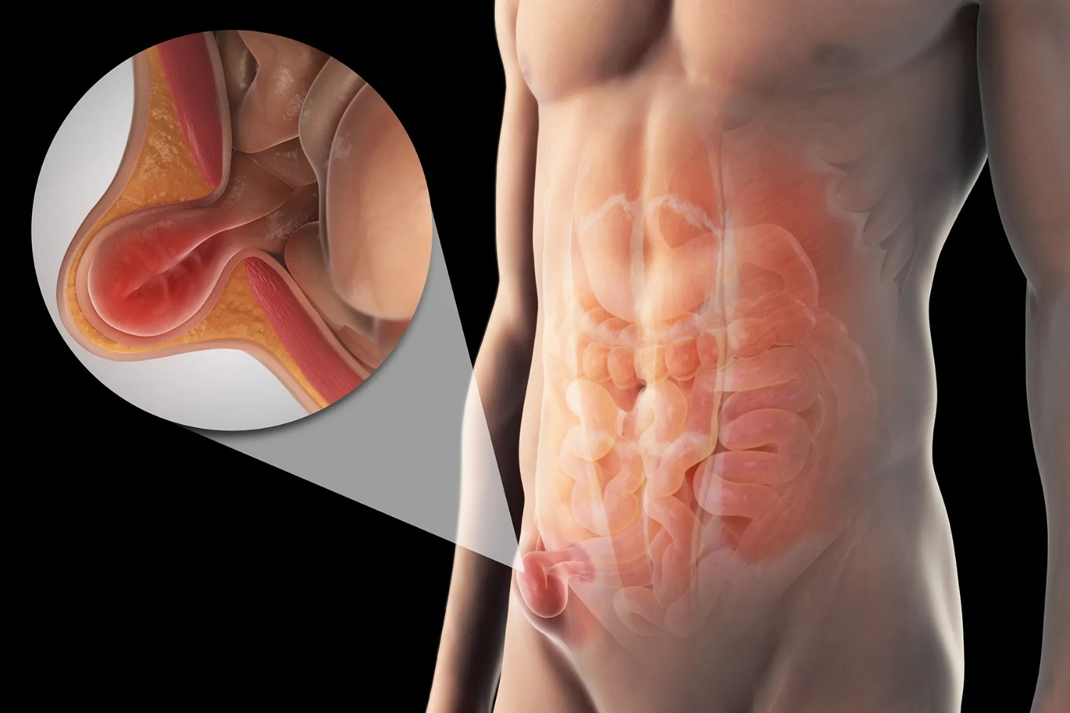 hernia-quiz