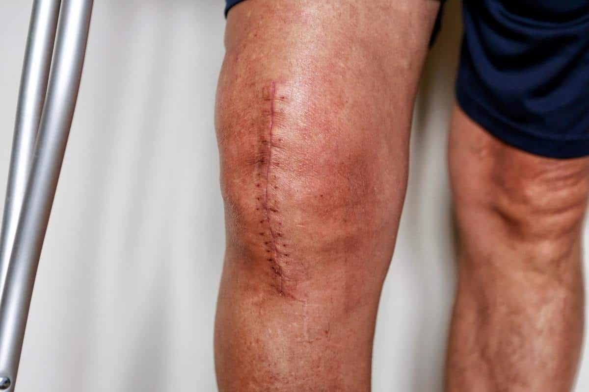 postoperative-knee-arthroplasty-quiz