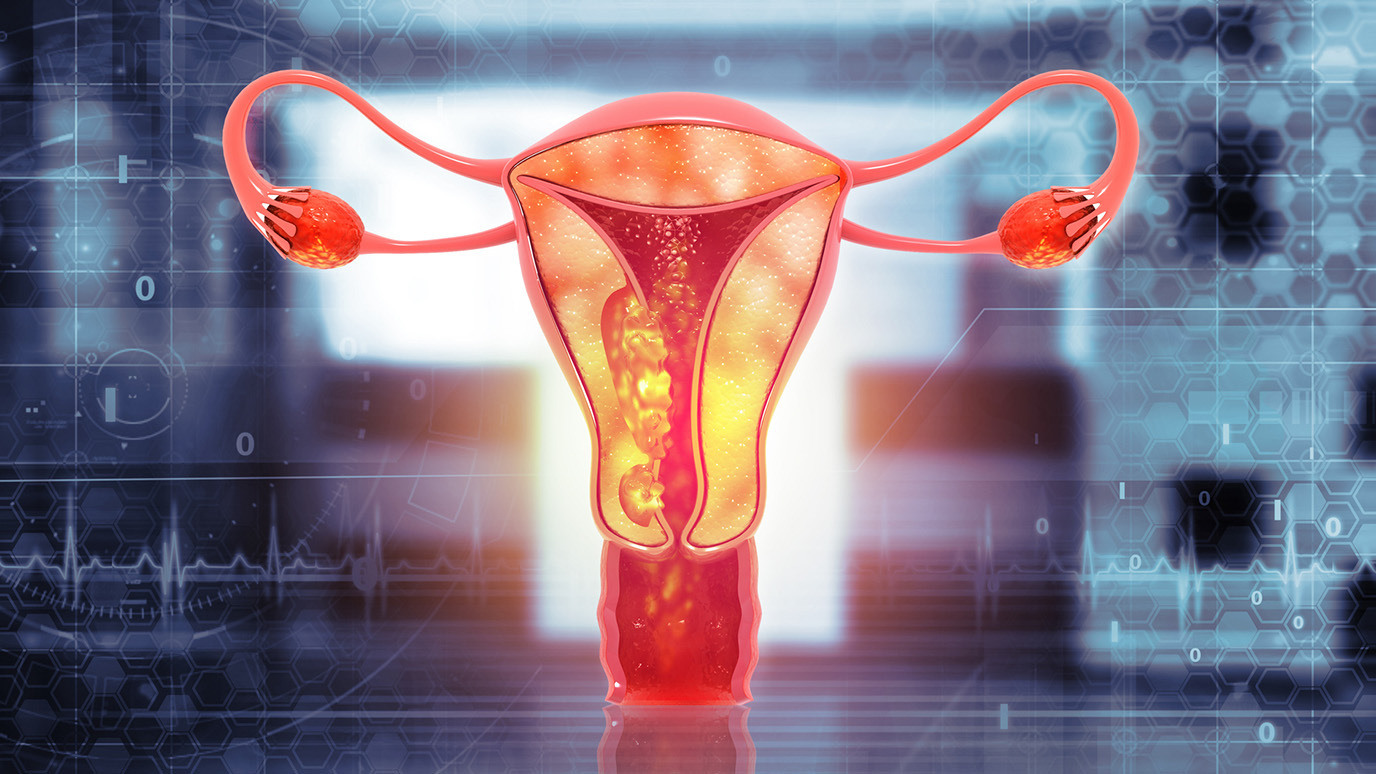 uterine-cancer-quiz